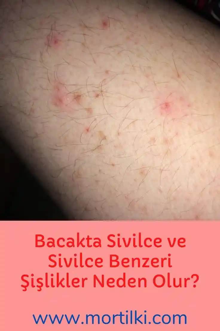Bacak Arasında Sivilce Nedenleri ve Etkili Çözüm Yolları