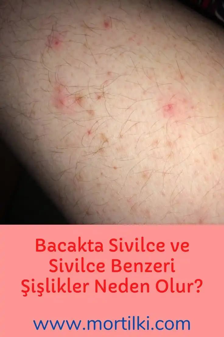 Bacak Arasında Sivilce Nedenleri ve Etkili Çözüm Yolları