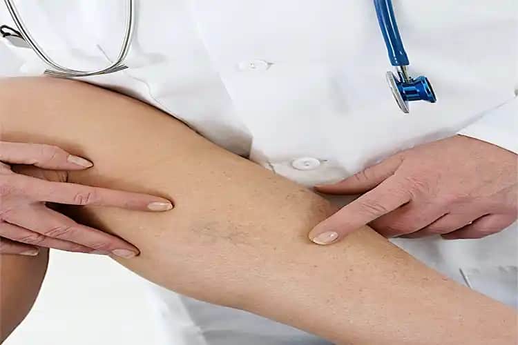 Bacaklardaki Güneş Lekeleri Nasıl Geçer: Nedenleri, Önleme ve Tedavi Yöntemleri