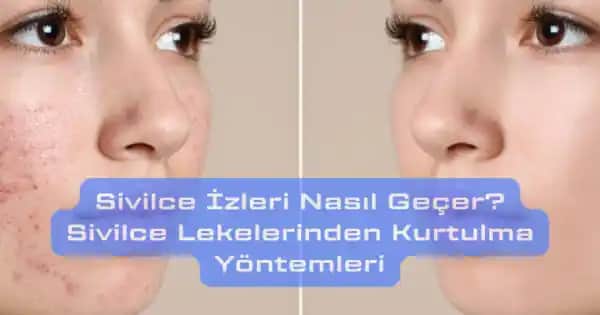 Bacaklardaki Sivilce İzleri Nasıl Geçer ve En Etkili Çözüm Yöntemleri Nelerdir?