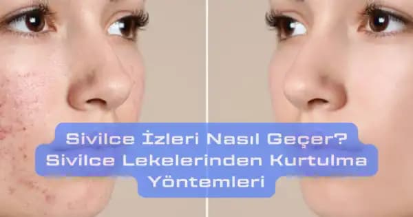 Bacaklardaki Sivilce İzleri Nasıl Geçer ve En Etkili Çözüm Yöntemleri Nelerdir?