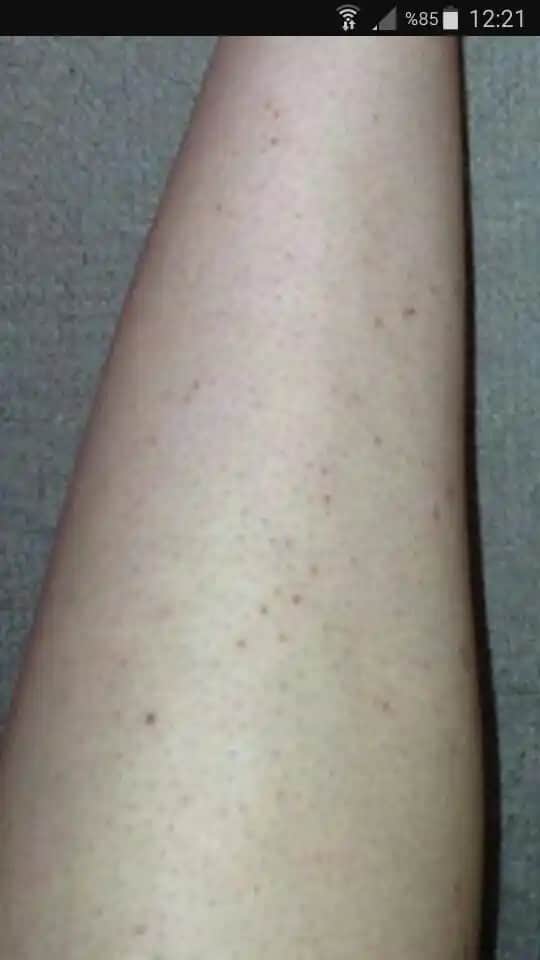 Bacaklardaki Siyah Kıl Köklerini Azaltmak ve Doğru Bakım Yöntemleri