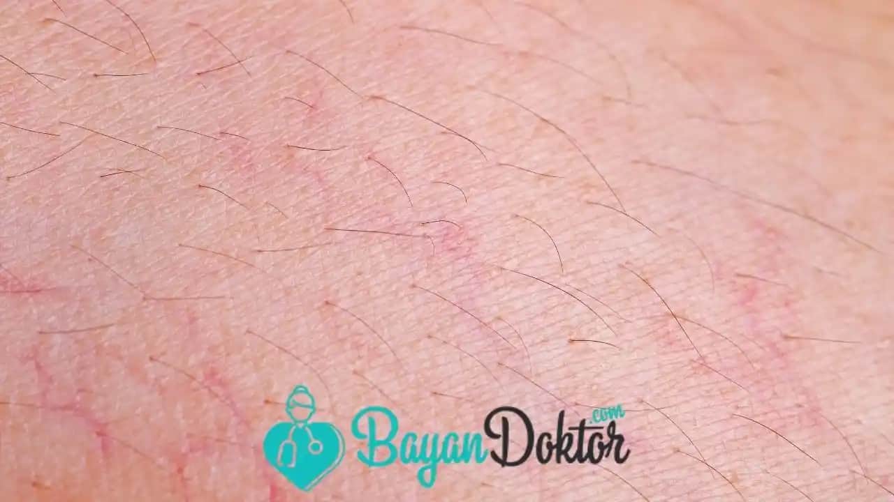 Bacakta Çatlak Belirtileri ve Cilt Sağlığını Koruma Yöntemleri