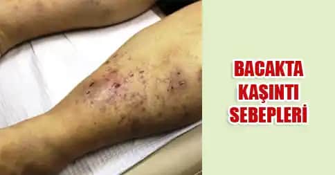 Bacakta Kaşıntı ve Yara Sorunlarına Yönelik Kozmetik Yaklaşımlar ve Çözüm Yolları