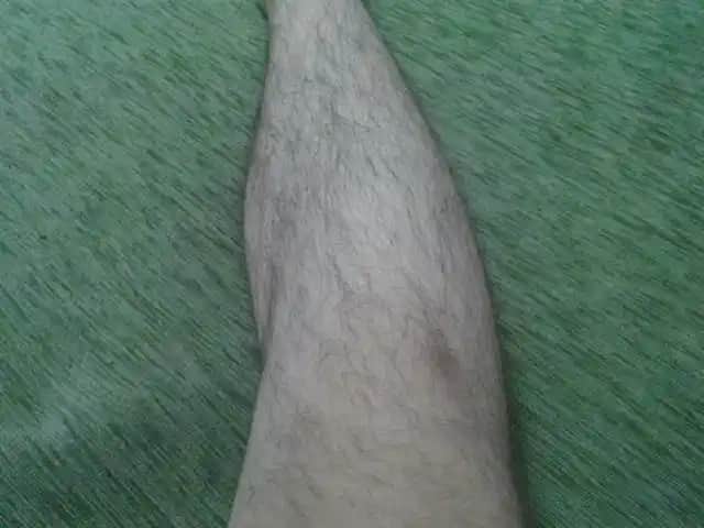 Bacakta Kısmi Kıl Dökülmesi Nedenleri ve Kozmetik Çözüm Yolları