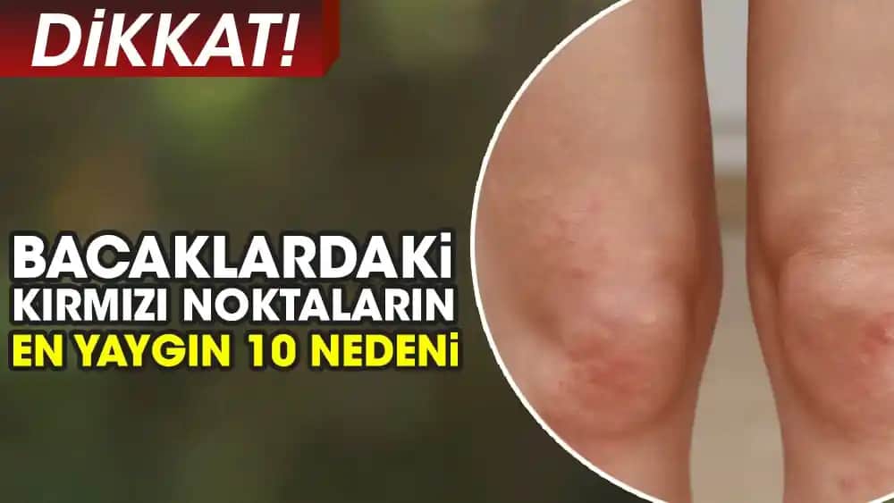 Bacakta Lekeler Neden Olur ve Doğru Tedavi Yöntemleri Nelerdir