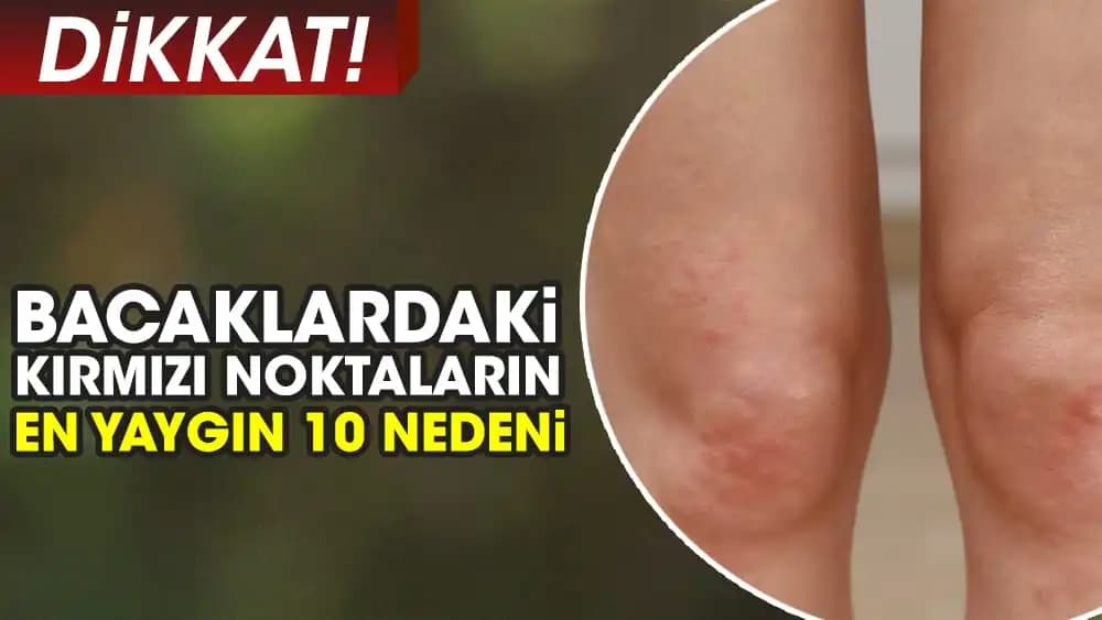 Bacakta Lekeler Neden Olur ve Doğru Tedavi Yöntemleri Nelerdir