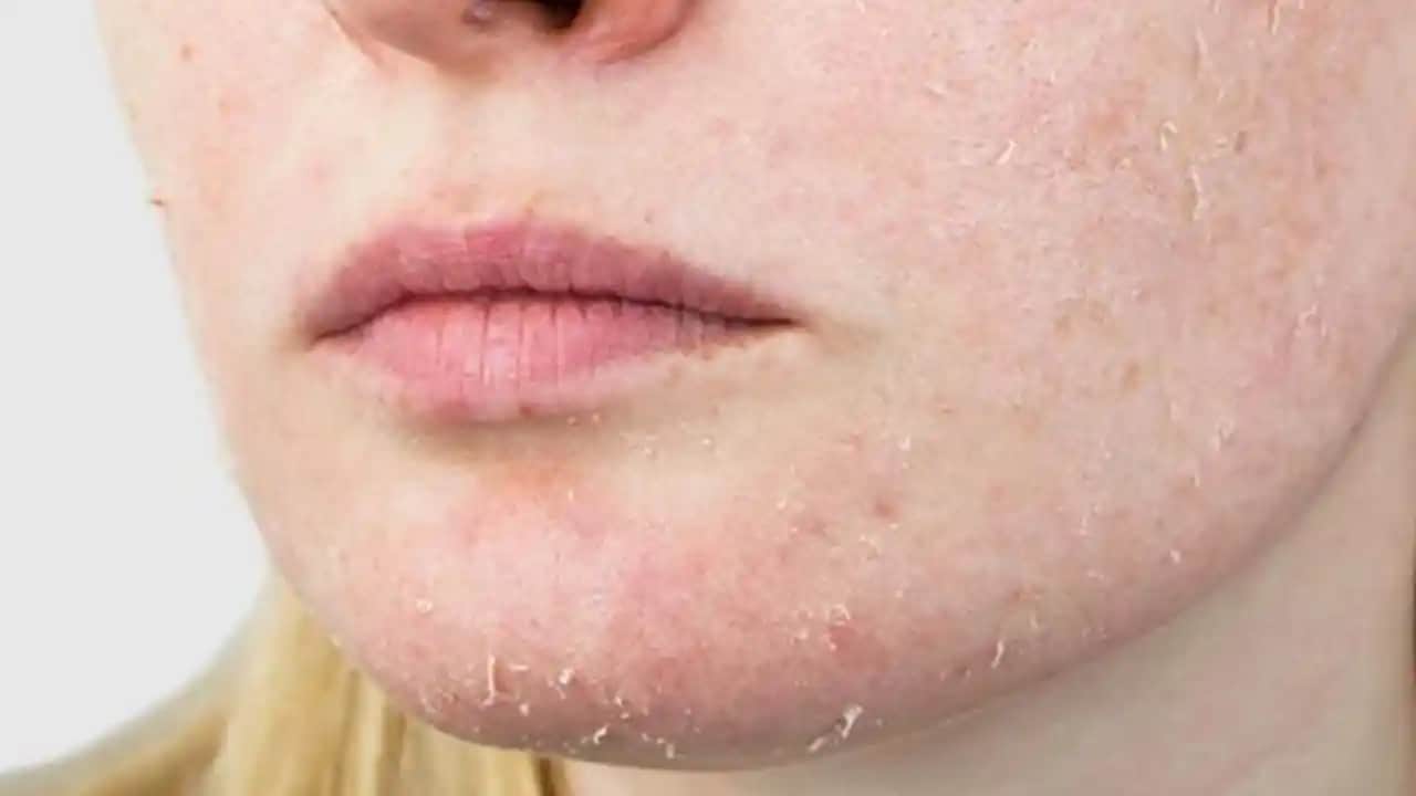 Bacakta Pul Pul Dökülme Nedenleri ve Etkili Tedavi Yöntemleri Hakkında Kapsamlı Bilgi