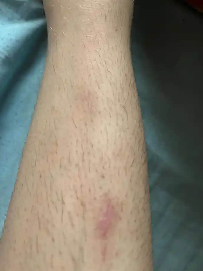 Bacakta Yaraların İyileşme Sürecini Hızlandıran Etkili Yöntemler ve Bakım İpuçları