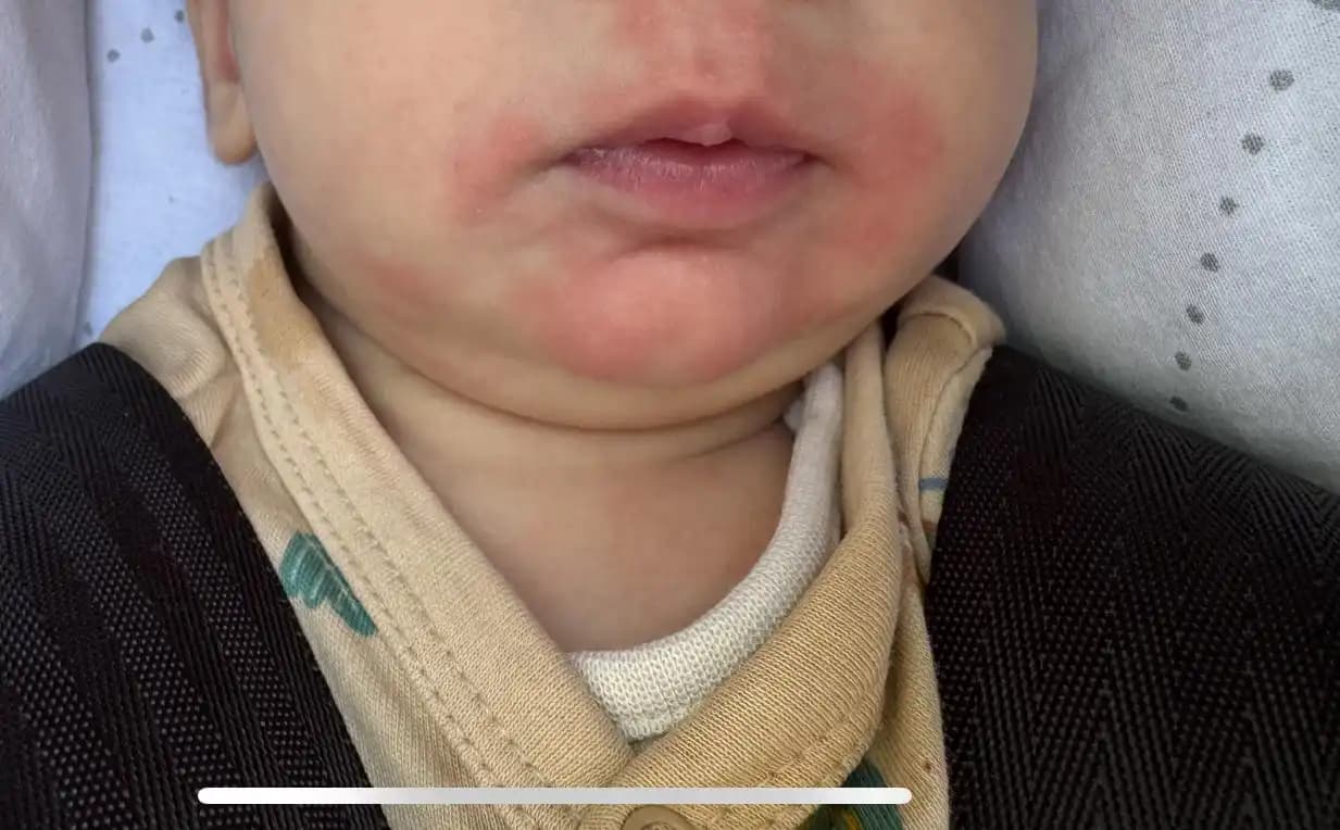 Bebek Boyun Altı Kızarıklıkları Nedenleri Belirtileri ve Doğal Çözüm Yöntemleri