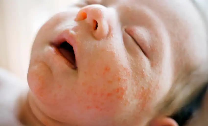 Bebek Cildinde Egzama: Kozmetik Yaklaşımlar ve Doğru Bakım Yöntemleri