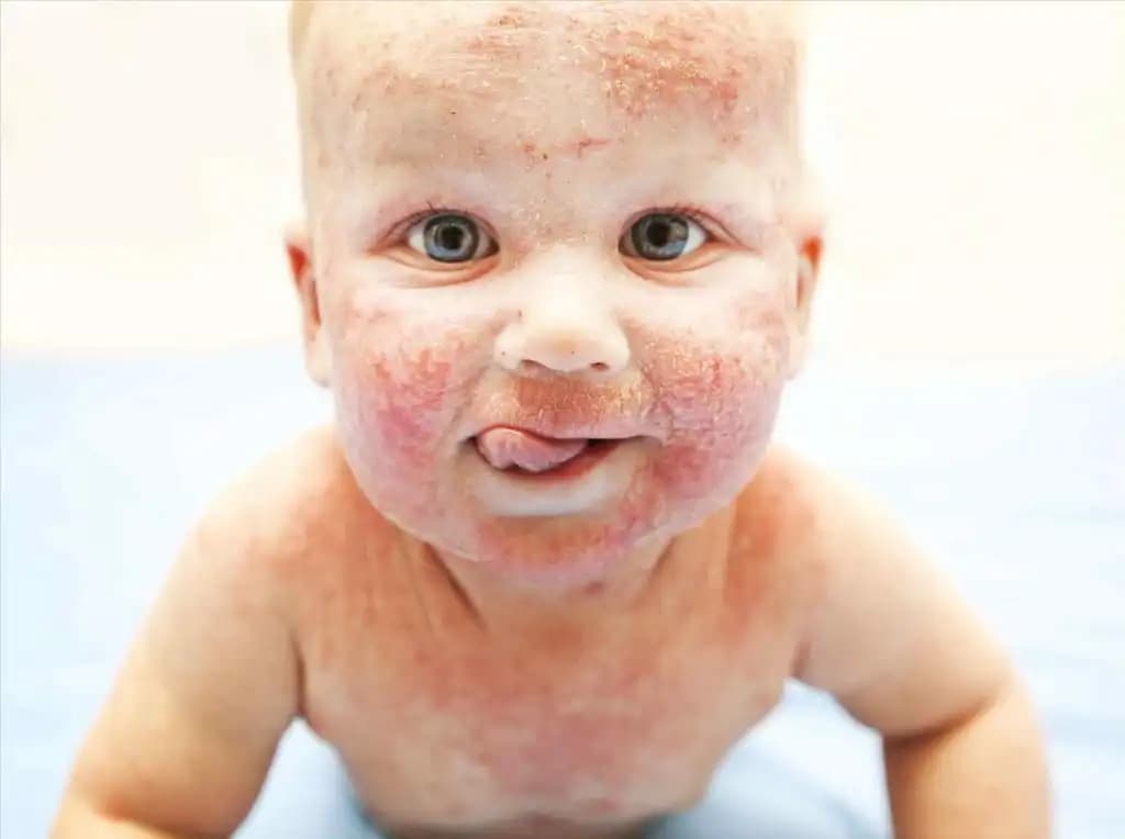 Bebek Dermatiti ve Cilt Sağlığına Yönelik Koruyucu ve Tedavi Yaklaşımları