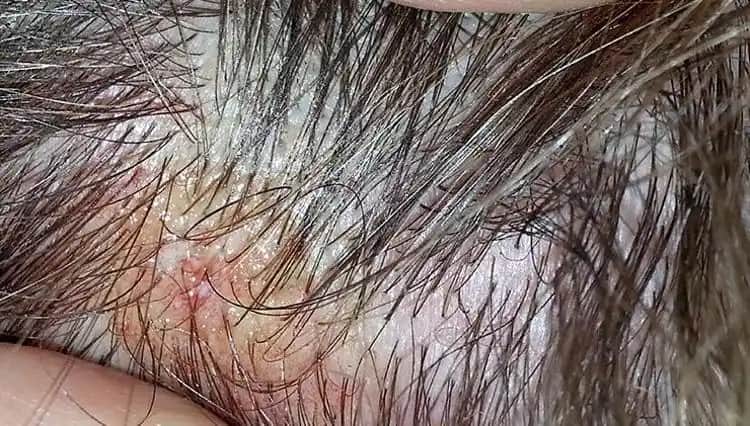 Bebek Saç Derisinde Kızarıklık Nedenleri Belirtileri ve Güvenli Bakım Yöntemleri