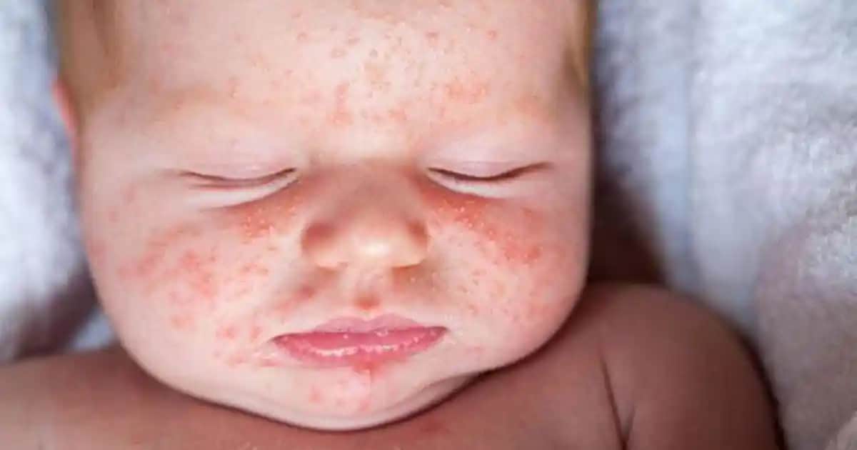 Bebeklerde Aniden Çıkan Kızarıklıkların Nedenleri ve Doğru Bakım Yöntemleri