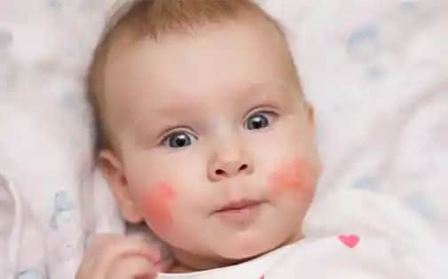 Bebeklerde Atopik Dermatit ve Güvenli Kozmetik Kullanımı Yöntemleri