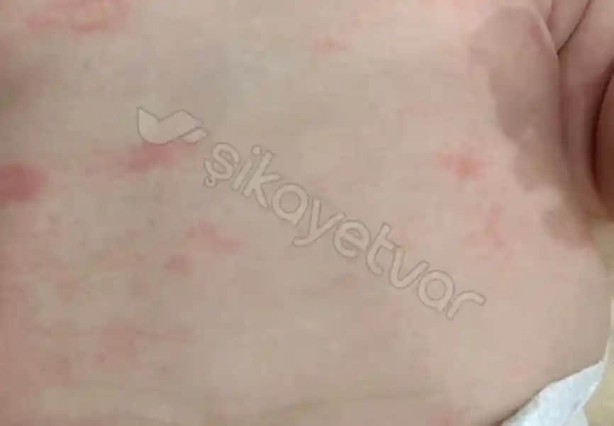 Bebeklerde Bacakta Kabarcıklar Nedenleri Belirtileri ve Alınacak Önlemler