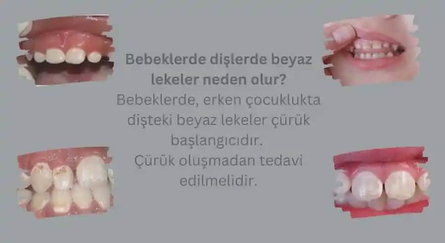 Bebeklerde Beyaz Lekeler: Nedenleri, Türleri ve Doğru Bakım Yöntemleri