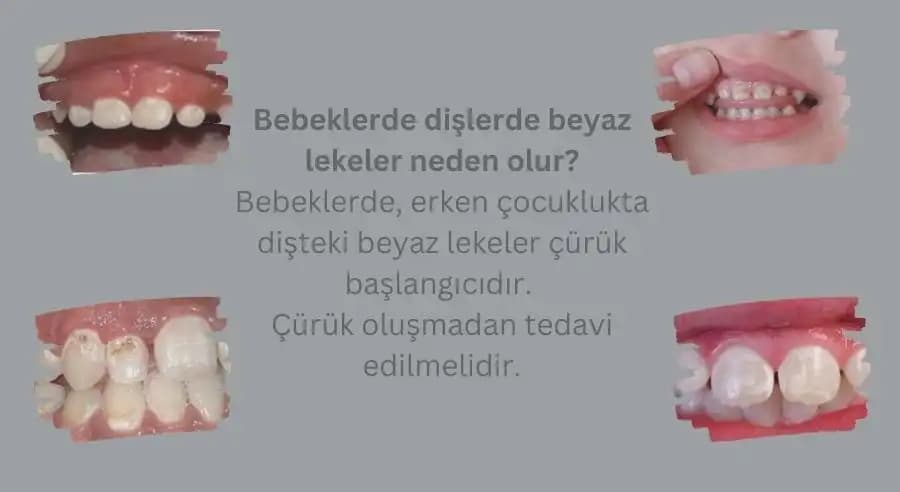 Bebeklerde Beyaz Lekeler: Nedenleri, Türleri ve Doğru Bakım Yöntemleri
