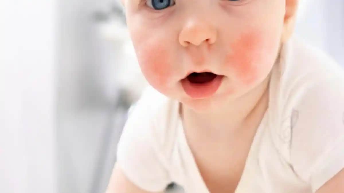 Bebeklerde Boyun Egzaması Nedenleri Belirtileri ve Bakım Yöntemleri