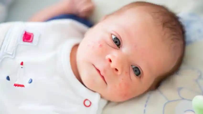 Bebeklerde Kafada İltihaplı Sivilce Nedenleri ve Etkili Çözüm Yöntemleri