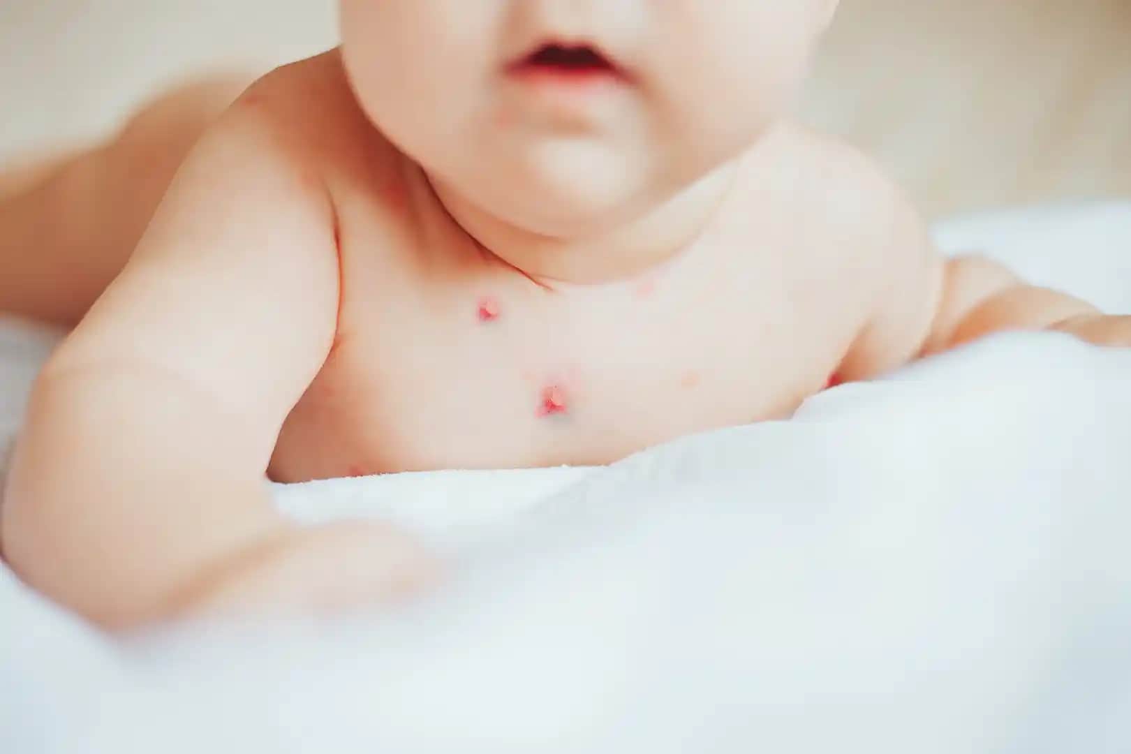 Bebeklerde Kol Kızarıklığının Nedenleri ve Doğru Bakım Yöntemleri