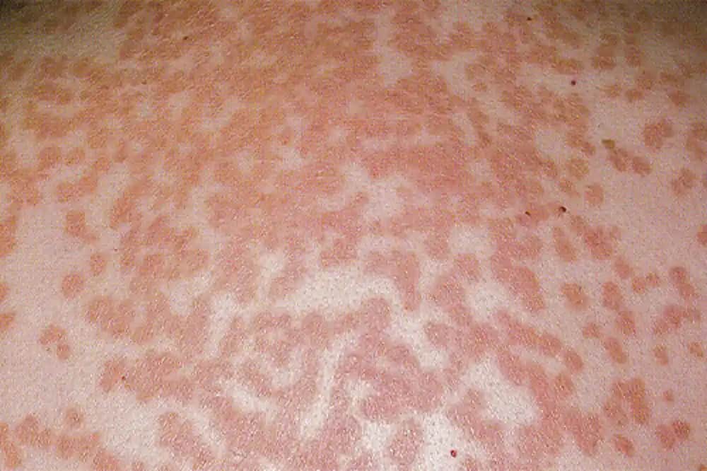 Bebeklerde Mantar Enfeksiyonu: Belirtileri, Nedenleri ve Korunma Yöntemleri