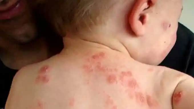 Bebeklerde Sedef Hastalığı: Belirtileri, Nedenleri ve Tedavi Seçenekleri Hakkında Kapsamlı Bilgi