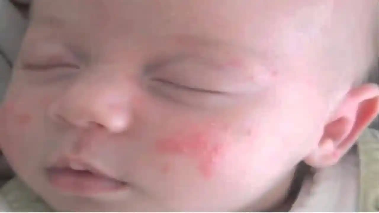 Bebeklerde Sivilce ve Kızarıklıkların Nedenleri, Belirtileri ve Çözüm Yolları