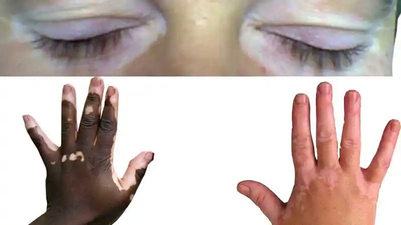 Bebeklerde Vitiligo Nedir, Belirtileri ve Tedavi Seçenekleri Hakkında Bilmeniz Gerekenler