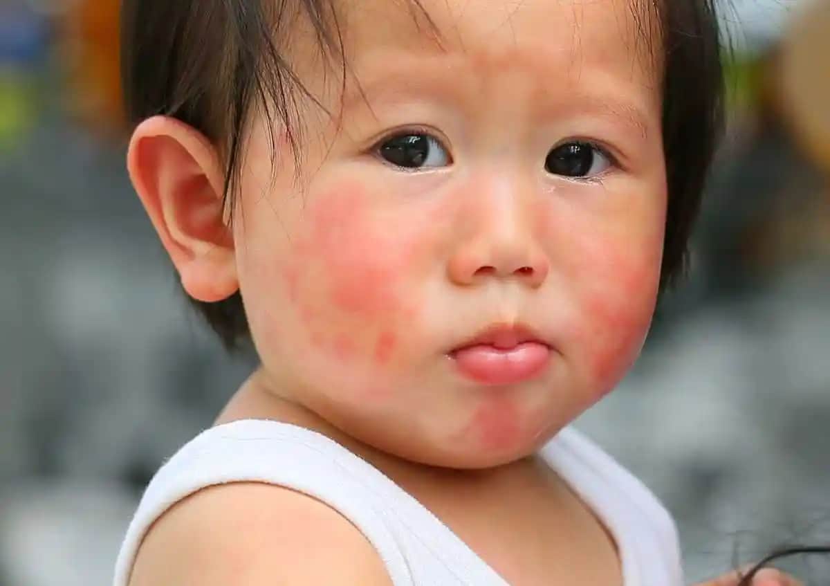 Bebeklerde Yüz Kuruluğu Nedenleri, Belirtileri ve Etkili Bakım Yöntemleri