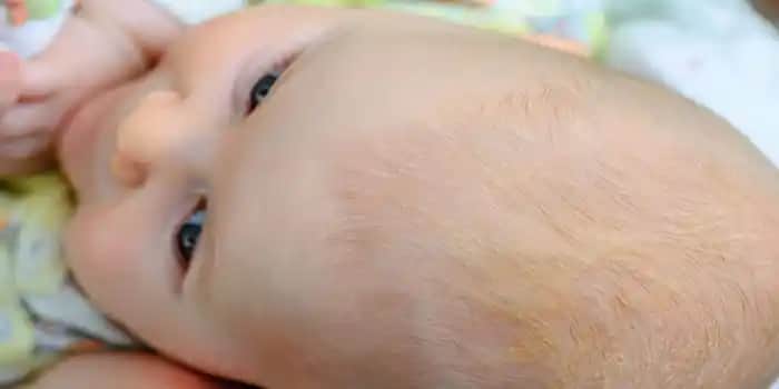 Bebeklerin Saç Diplerindeki Sarı Kabuklanmanın Nedenleri ve Doğal Çözüm Yöntemleri