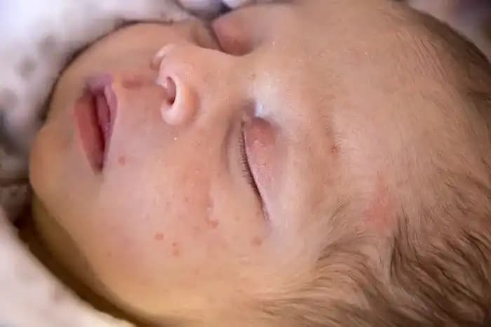Bebeklerin Yüzünde Çıkan Sivilceler: Nedenleri, Önlemleri ve Ebeveynlere Tavsiyeler