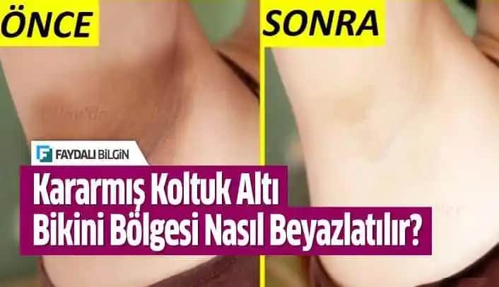 Bikini Bölgesini Güvenilir Yöntemlerle Beyazlatma ve Kararma Önleme Rehberi