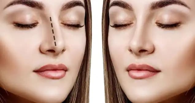 Burun Dikiş İzi Nasıl Geçer Estetik ve Sağlık Açısından Etkili Çözüm Yolları