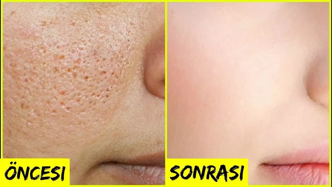 Burun Gözenekleri Sıkılaştırma Yöntemleri ve Cilt Sağlığı İpuçları
