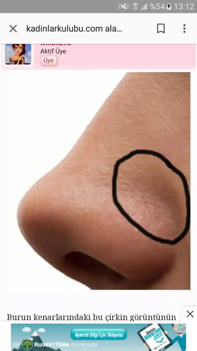 Burun Kenarlarında Soyulmanın Nedenleri ve Etkili Çözüm Yöntemleri