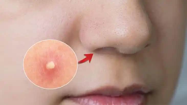 Burunda Ağrılı Sivilceler: Nedenleri, Tedavi Yöntemleri ve Doğal Çözümler