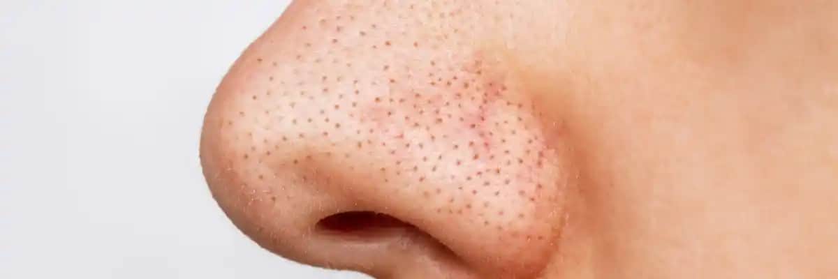 Burunda Kapalı Komedonlar: Nedenleri, Belirtileri ve Etkili Tedavi Yöntemleri