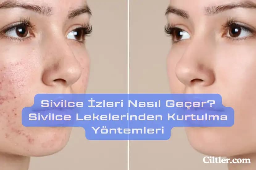 Burundaki Sivilce İzleri Nasıl Geçer: Etkili Yöntemler ve Bakım İpuçları