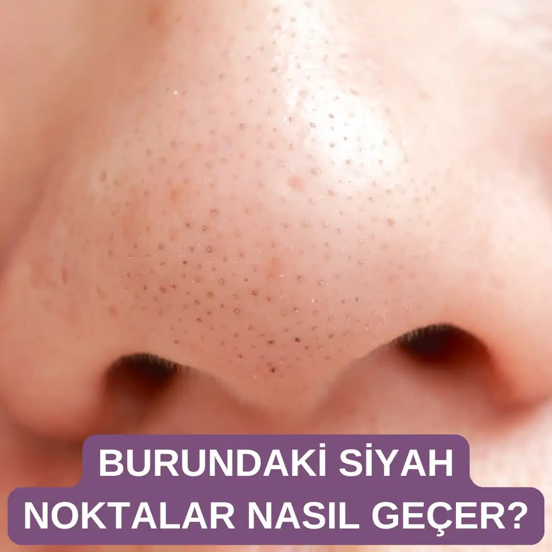 Burundaki Siyah Noktalar Nasıl Geçer Evde Uygulanabilir Etkili Yöntemler ve İpuçları
