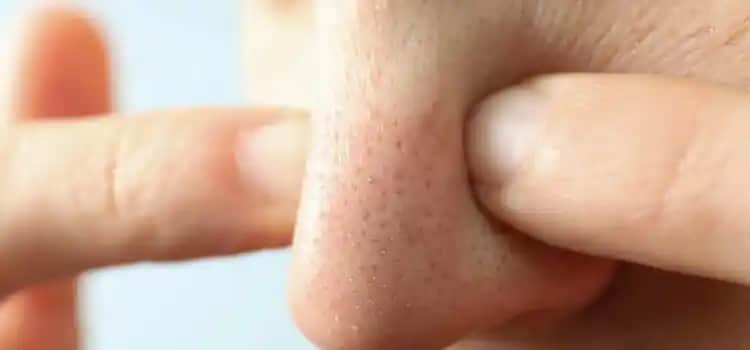 Burundaki Siyah Noktaları Sıkmak Riskleri ve Güvenli Cilt Bakım Yöntemleri