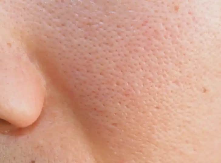 Büyük Gözeneklerin Nedenleri ve Etkili Çözüm Yöntemleri Kozmetik ve Doğal Bakım