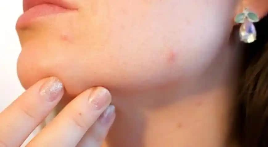 Çene Bölgesi Sivilcelerinin Nedenleri ve Etkili Çözüm Yolları Hakkında Detaylı Bilgi