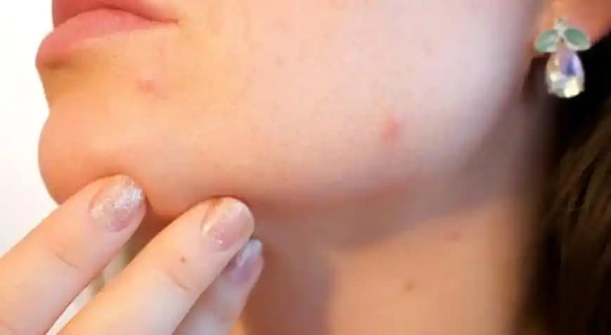 Çene Bölgesi Sivilcelerinin Nedenleri ve Etkili Çözüm Yolları Hakkında Detaylı Bilgi