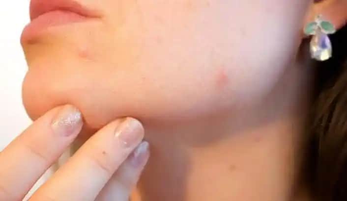 Çene Bölgesinde Sivilce Nasıl Geçer Detaylı Tedavi ve Önleme Yöntemleri