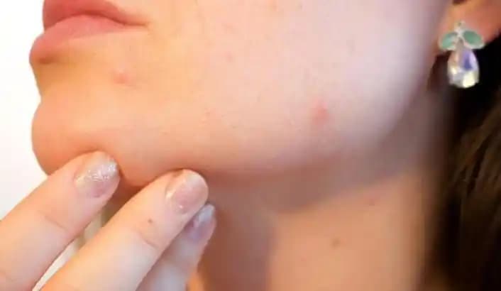 Çene Bölgesinde Sivilce Nasıl Geçer Detaylı Tedavi ve Önleme Yöntemleri