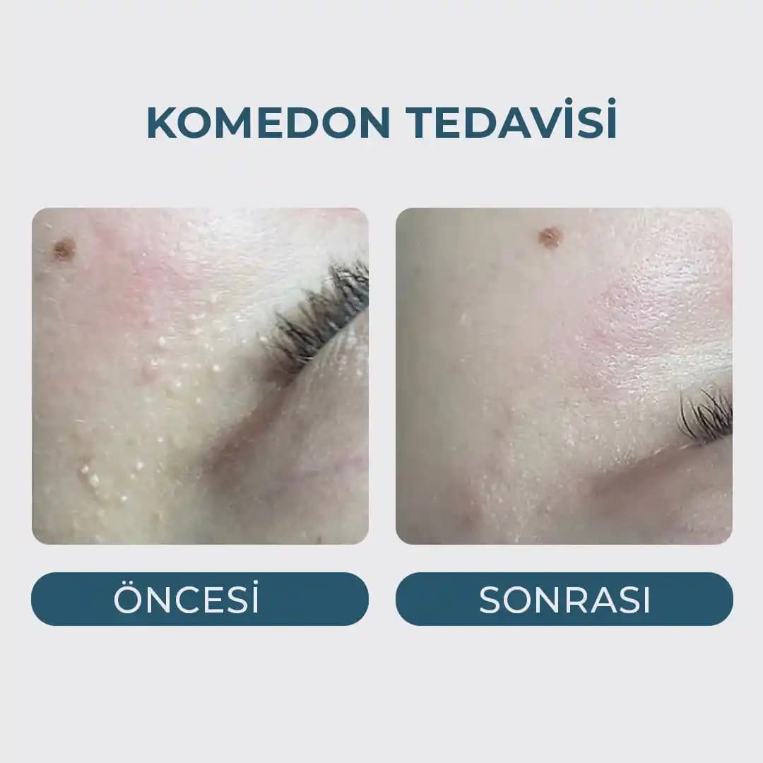 Çenede Komedonler: Nedenleri, Temizlik Yöntemleri ve Koruyucu Tavsiyeler