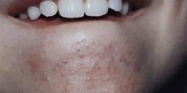 Çenedeki Siyah Noktalar Nasıl Geçer Güncel ve Etkili Çözüm Yöntemleri