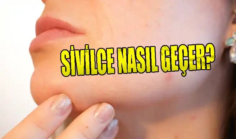 Çenedeki ve Yüzdeki Sivilce Lekeleri Nasıl Geçer Güncel ve Güvenilir Yöntemler