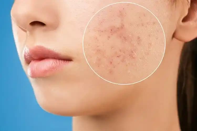 Çıkmak Üzere Olan Sivilcelerle Başa Çıkma ve Cilt Sağlığını Koruma Yöntemleri